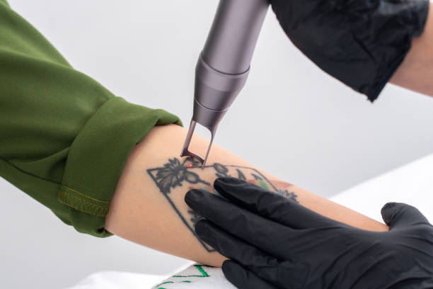 détatouage laser à Villefranche