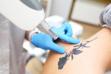 détatouage laser à Villefranche